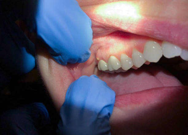Best Tooth Infection Emergency Dentist  in Lowellville, OH